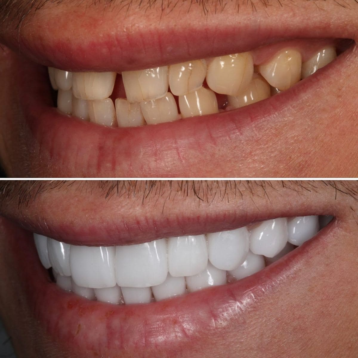 Restoration crafted by Strupp & Brumm in-house dental lab — piece 51