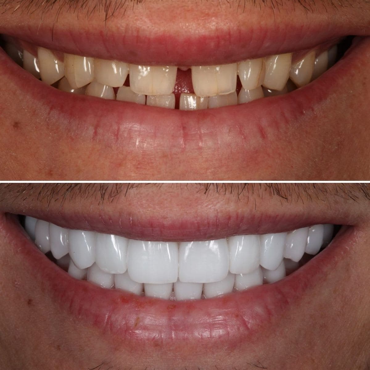 Restoration crafted by Strupp & Brumm in-house dental lab — piece 52