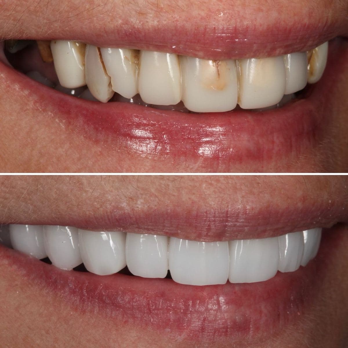 Restoration crafted by Strupp & Brumm in-house dental lab — piece 53