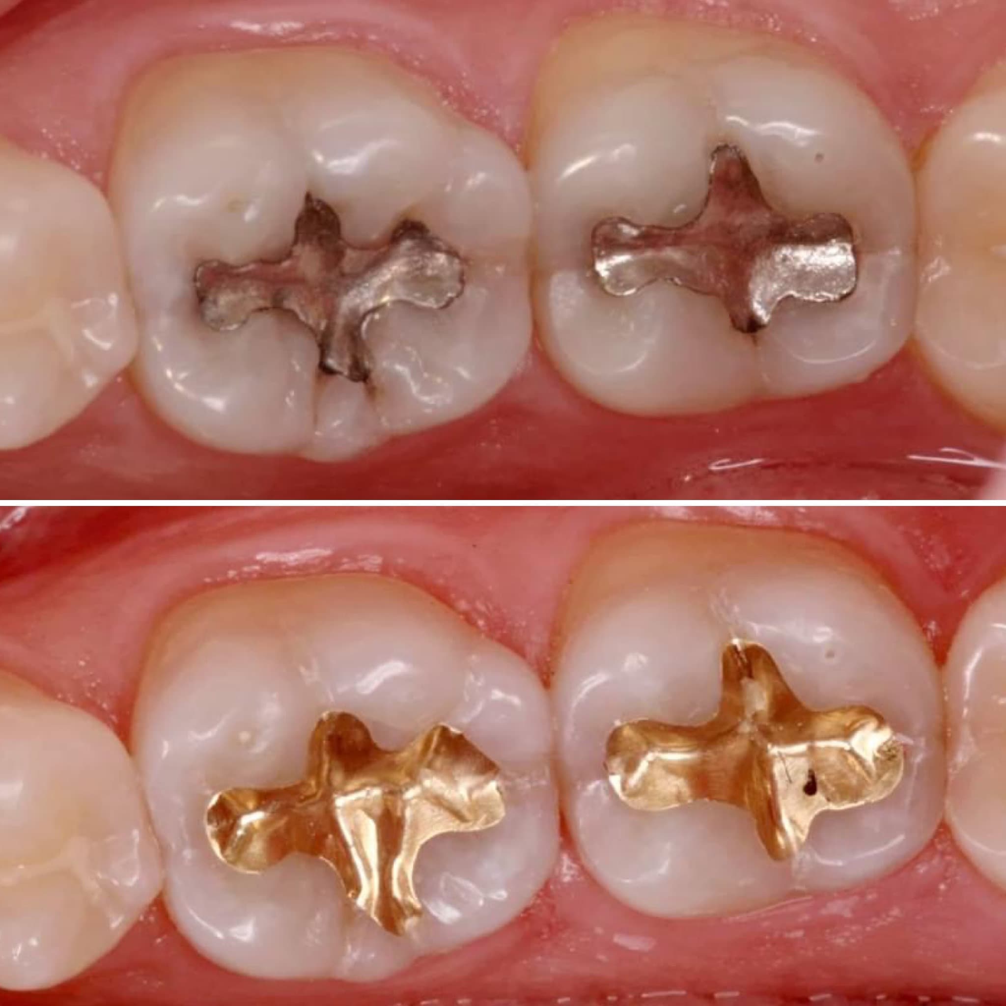 Restoration crafted by Strupp & Brumm in-house dental lab — piece 54