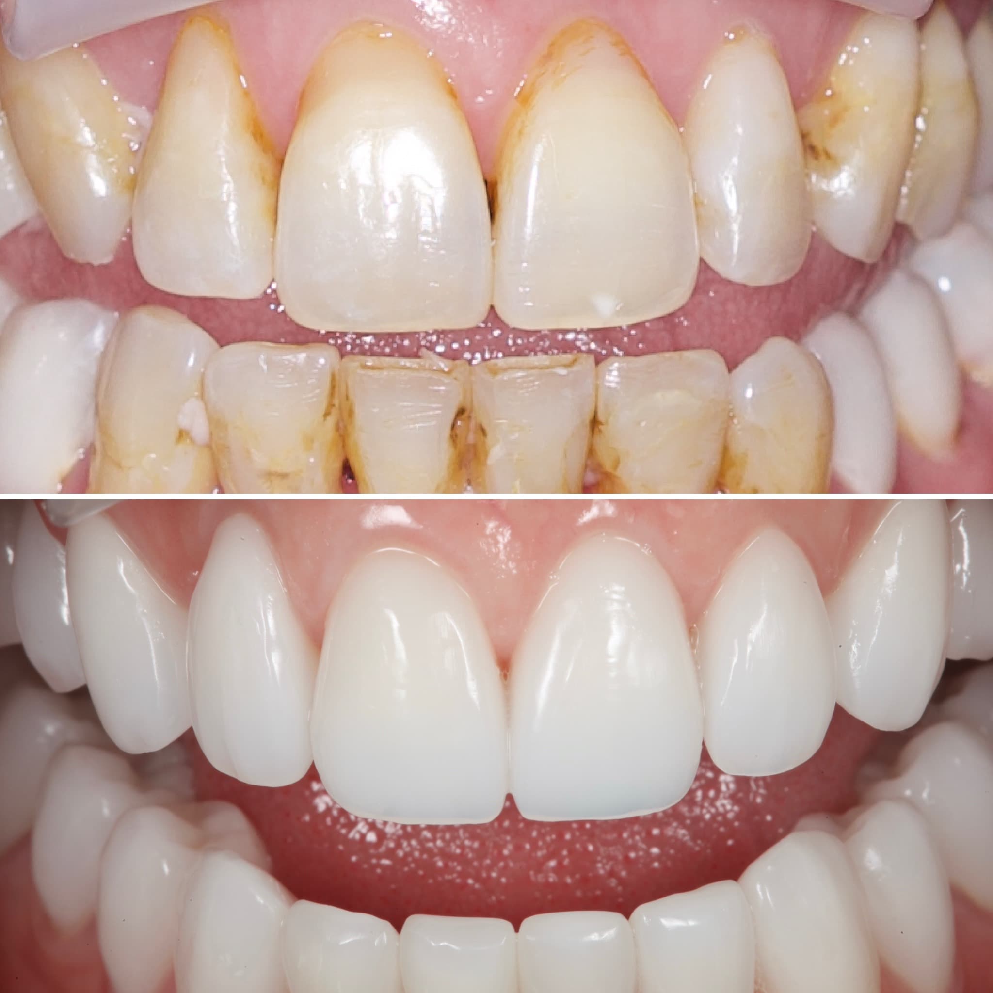Restoration crafted by Strupp & Brumm in-house dental lab — piece 55