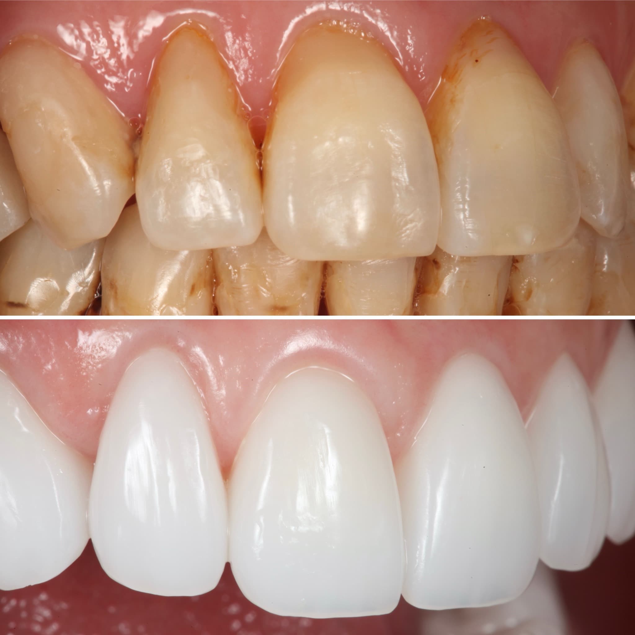 Restoration crafted by Strupp & Brumm in-house dental lab — piece 56