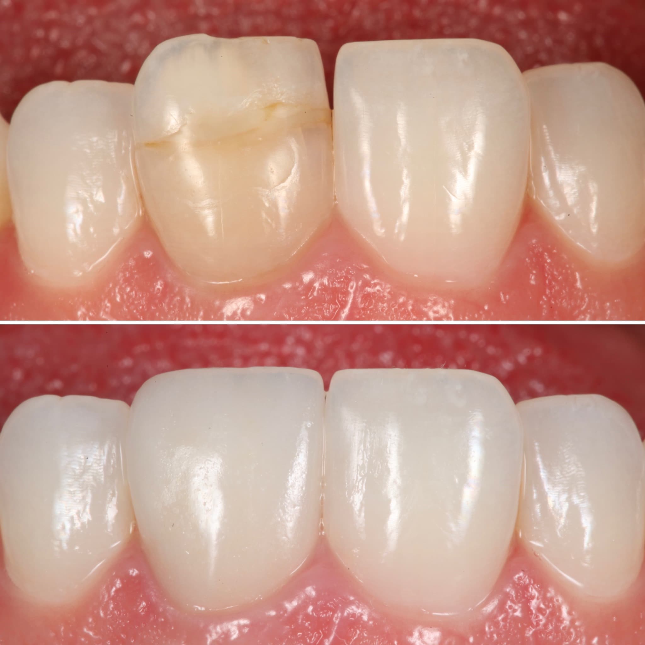Restoration crafted by Strupp & Brumm in-house dental lab — piece 57