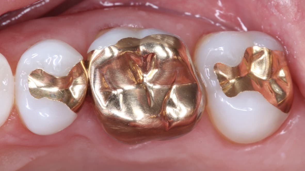 Gold restoration crafted at Strupp & Brumm — example 1