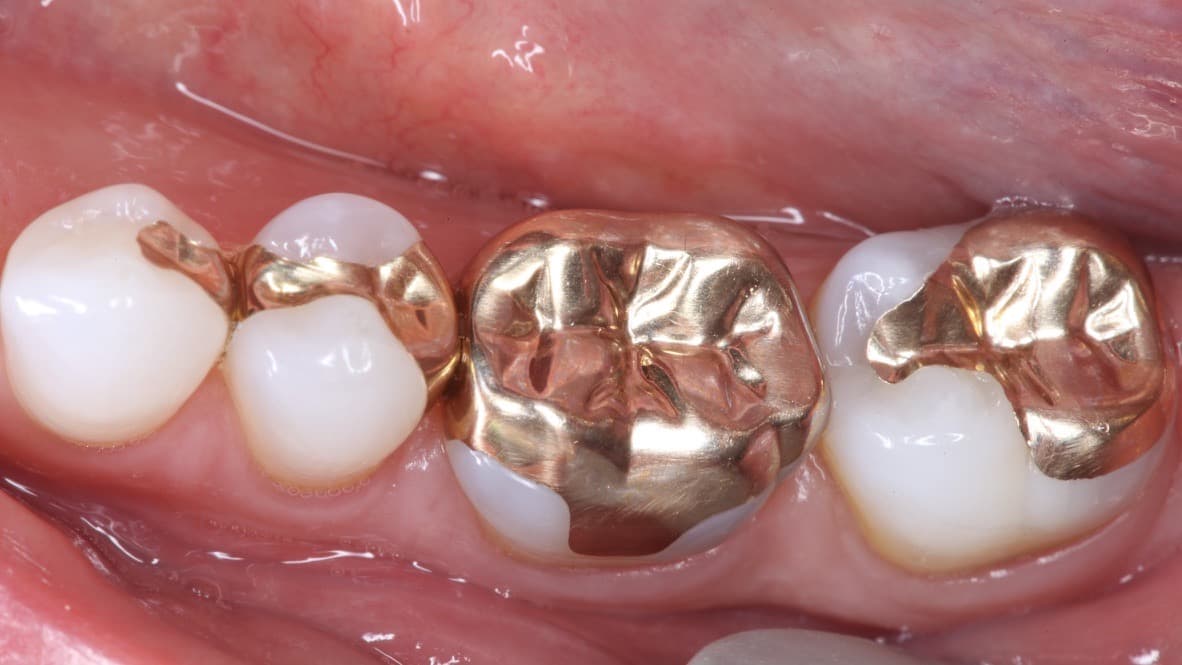 Gold restoration crafted at Strupp & Brumm — example 2
