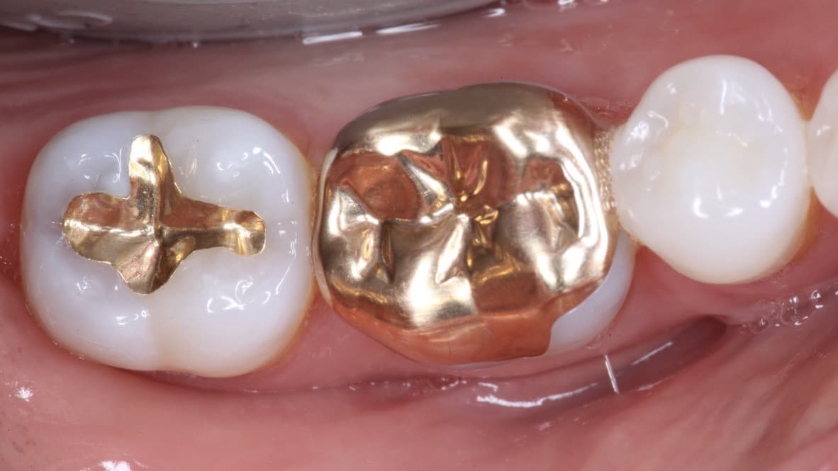 Gold restoration crafted at Strupp & Brumm — example 3